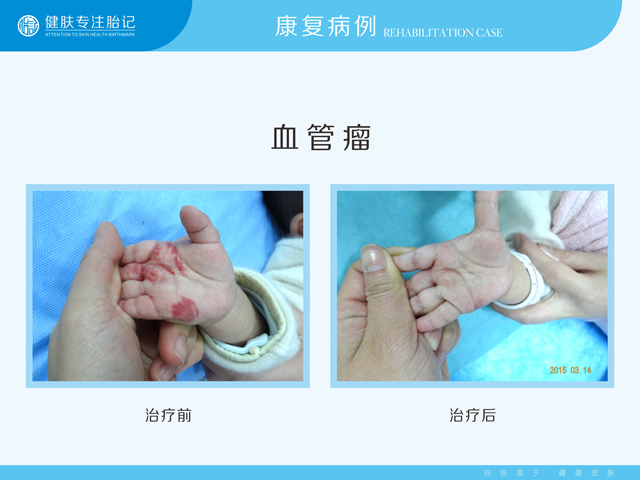 广州治疗血管瘤哪种技术安全有效