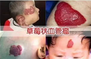 广州健肤能不能治草莓状血管瘤