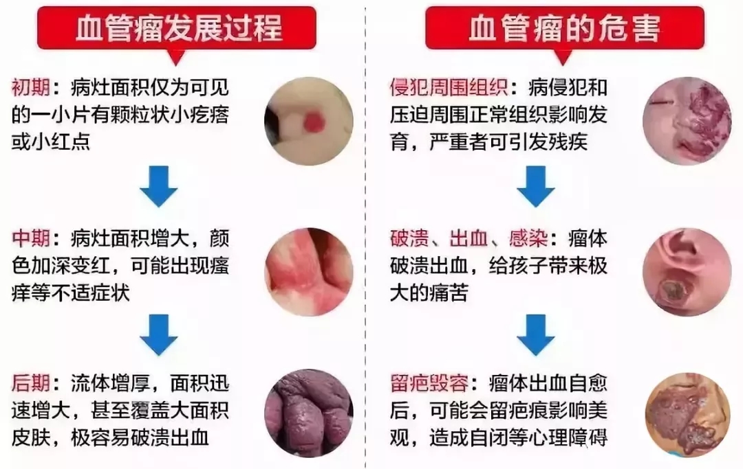 广州专科医院治疗血管瘤贵不贵