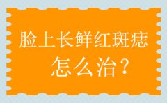 广州鲜红斑痣医院哪家好？如何治疗鲜红斑痣呢？